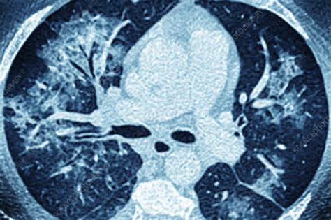 Pulmonary vasculitis, CT scan - Stock Image - C055/6167 - Science Photo ...