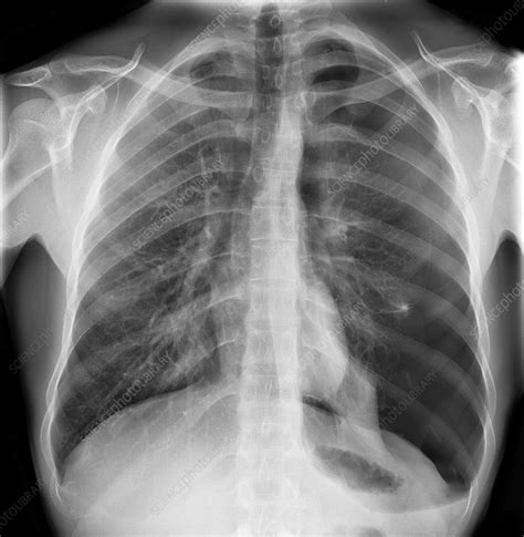 Pneumothorax Chest X Ray