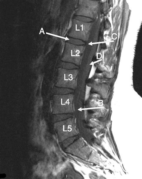 Mri Lumbar Spine Labeled