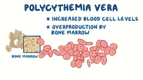 Polycythemia vera (NORD): Video, Anatomy & Definition | Osmosis