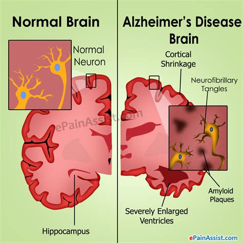 Alzheimer’s Disease |Causes|Stages|Treatment|Prognosis