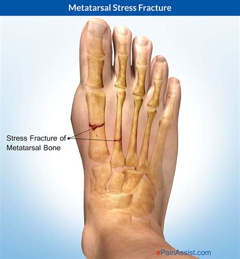 Metatarsal Stress Fracture: Treatment, Symptoms, Recovery, Causes