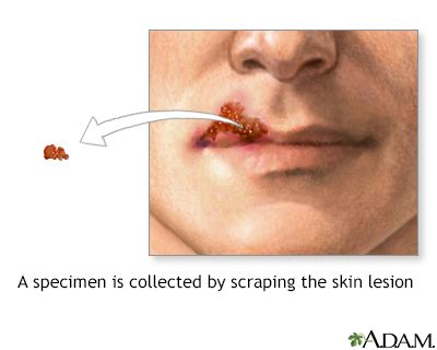 Herpes viral culture of lesion Information | Mount Sinai - New York