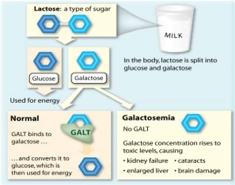 Galactosemia – Decode Genomics