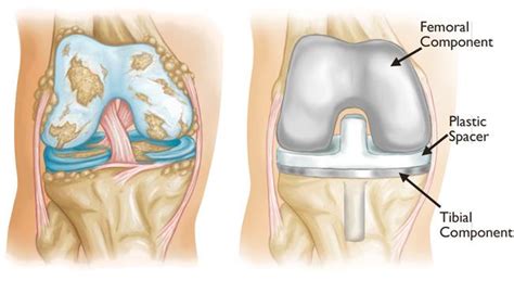 MLD and total knee replacement