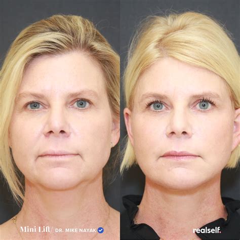 Discover the Benefits of a Mini Facelift