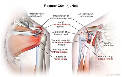 Medmovie.com | Rotator Cuff Injuries