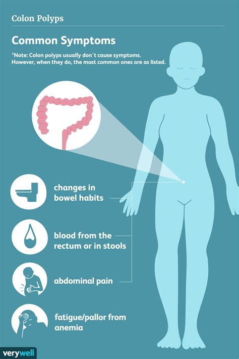 [Aktualisieren] Overview and Types of Colon Polyps | what does a colon ...