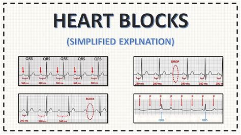 Different Types Of Heart Blocks