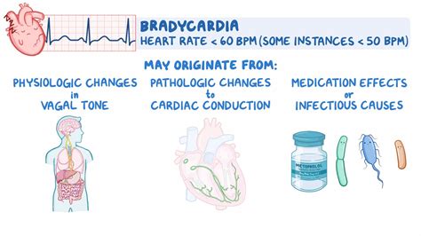 Approach to bradycardia: Clinical sciences - Osmosis Video Library