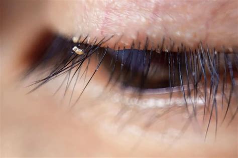 Itching and redness in eyes can be the symptoms of eyelash lice ...