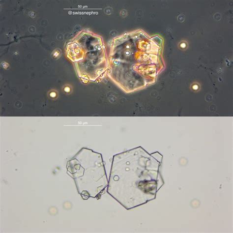 Urine Sediment of the Month: Cystine Crystals - Renal Fellow Network