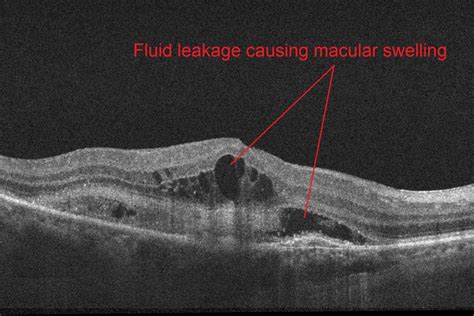 AMD with fluid - Retina Doctor