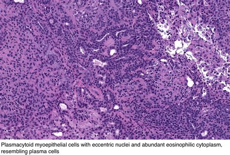 Pathology Outlines - Pleomorphic adenoma