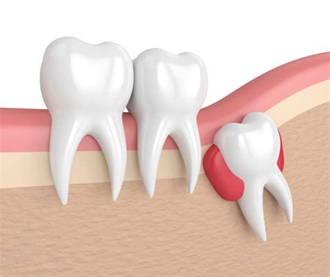 Impacted Teeth Complications - Brampton, ON - Salvaggio Dentistry