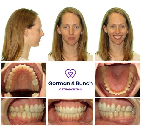 Invisalign Before and After Stories With Our Patients – Gorman & Bunch