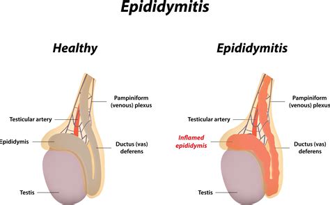 Epididymal Cyst