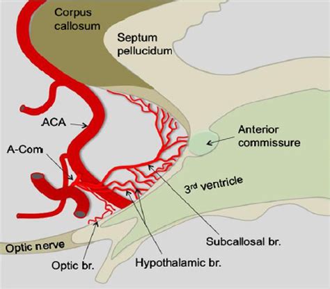 (Meila D et al 9 ) Schematic drawing of the anterior communicating ...