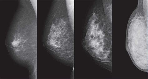 What Does Breast Cancer Look Like On A Mammogram