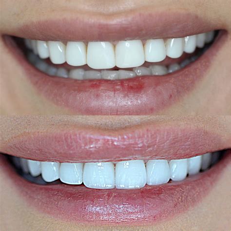 Porcelain & Composite Veneers Hamilton | Tulip Dental