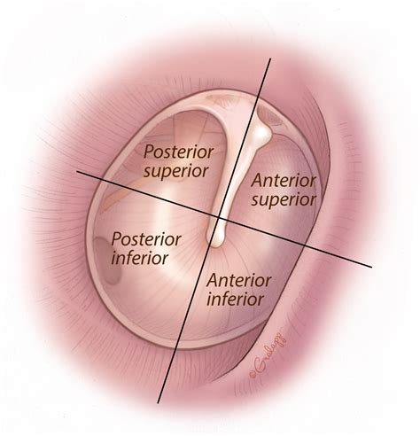 Tympanic Membrane Perforation Repair