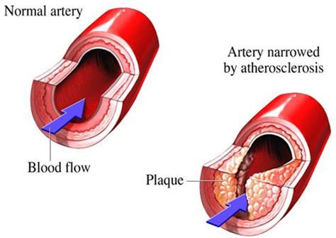 Treating renal artery stenosis in New Jersey