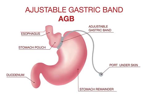 Adjustable Gastric Band - Wilmington Health