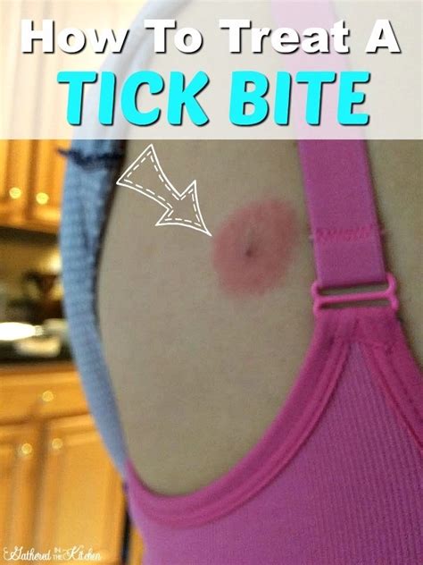 What To Do If You Get A Tick Bite - Gathered In The Kitchen