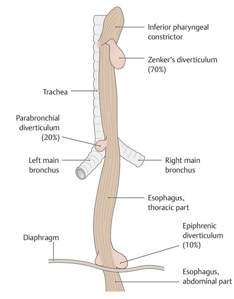 Diverticulum Types