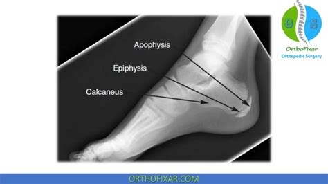 Sever Disease Radiology, Symptoms & Treatment | OrthoFixar 2024