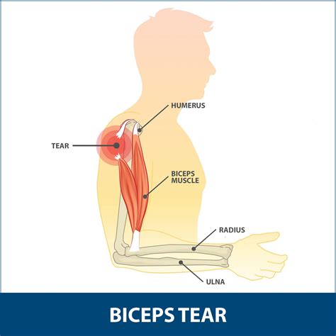 Biceps Tenodesis - Arthromed - Arthroscopy & Joint Replacement Centre ...