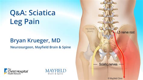 Q&A: Sciatica leg pain w/ Dr. Bryan Krueger