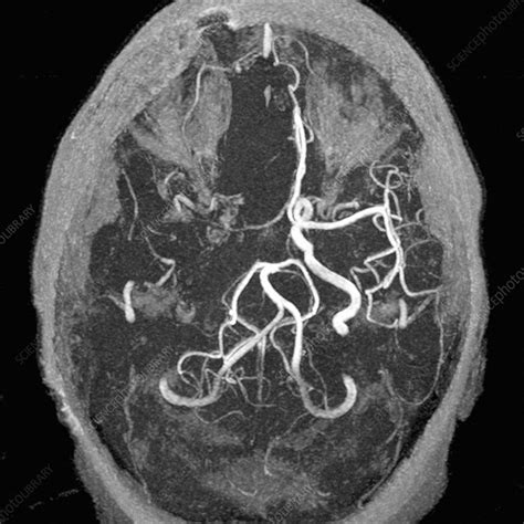 Stroke, MRA scan - Stock Image M136/0291 - Science Photo Library