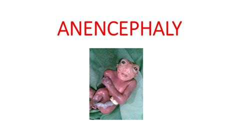 ANENCEPHALY - YouTube