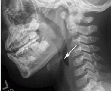 Upper Airway Obstruction | Radiology Key