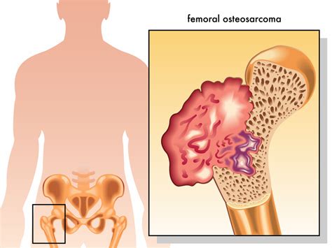 Osteosarcoma Symptoms May Point to a Rare Type of Cancer - University ...