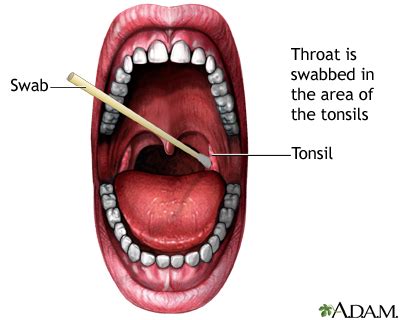 Throat swab culture Information | Mount Sinai - New York