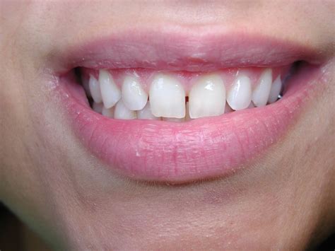 Dental Bonding: A Relatively Inexpensive Way to Close Gaps Between ...