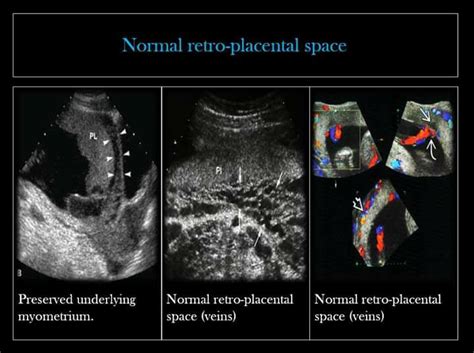 ___Retro-placental Space. *... - Ultrasound Guided Tips