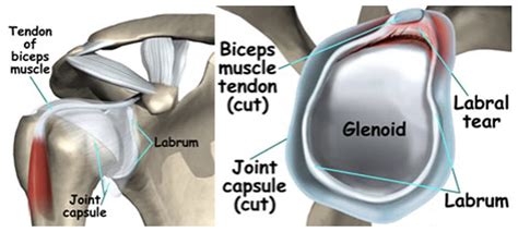 Anatomy Shoulder Labrum Tear