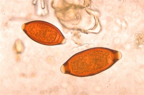 Trichuris trichiura | Medical Laboratories