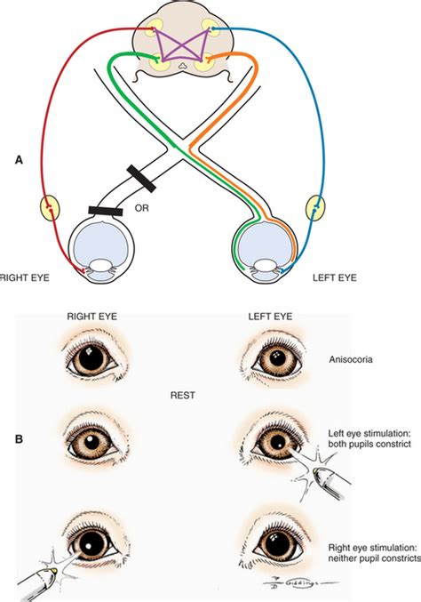 Corneal Light Reflex