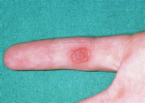 Large Common Wart On The Finger Photograph by Dr P. Marazzi/science ...