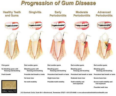 Gum Disease (Gingivitis): Causes, Risk Factors ,Symptoms and Treatment