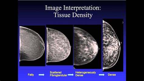 Introduction to Mammography - YouTube