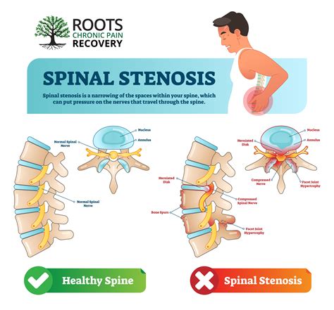 Pin on Chronic Pain