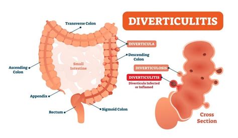 Diverticulitis Treatments - Facty Health