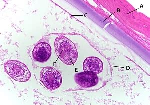 Echinococcus Cysts