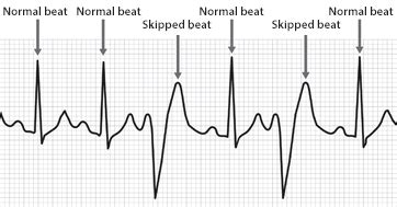 Erratic Heartbeat