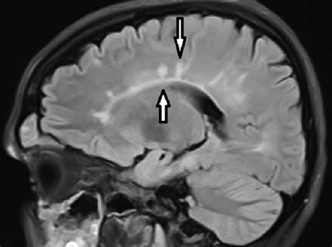 Multiple Sclerosis Mri Dawsons Fingers